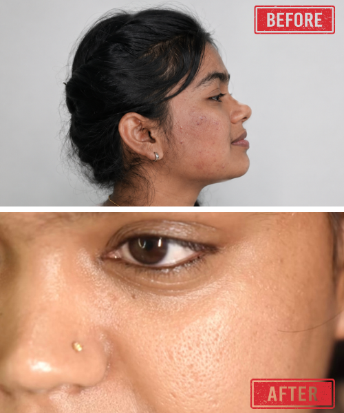 Microneedling for acne scars showing before and after skin improvement in Bangalore clinic